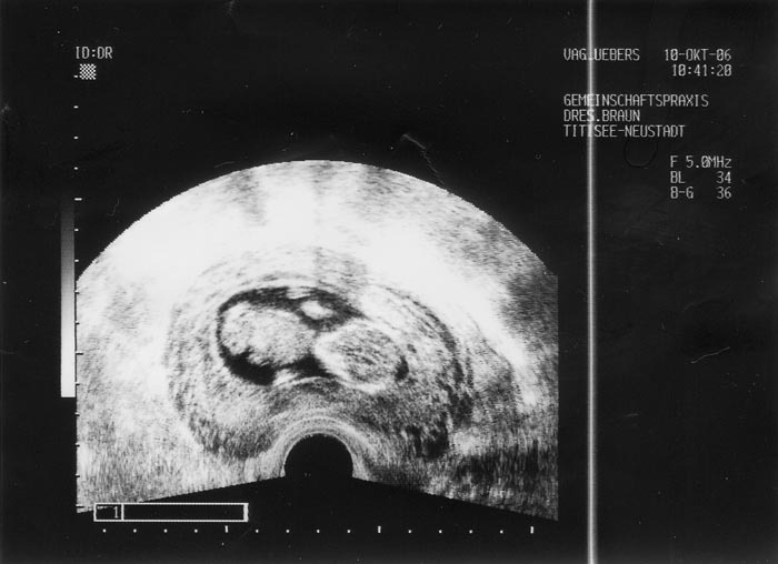 2. Ultraschallaufnahme