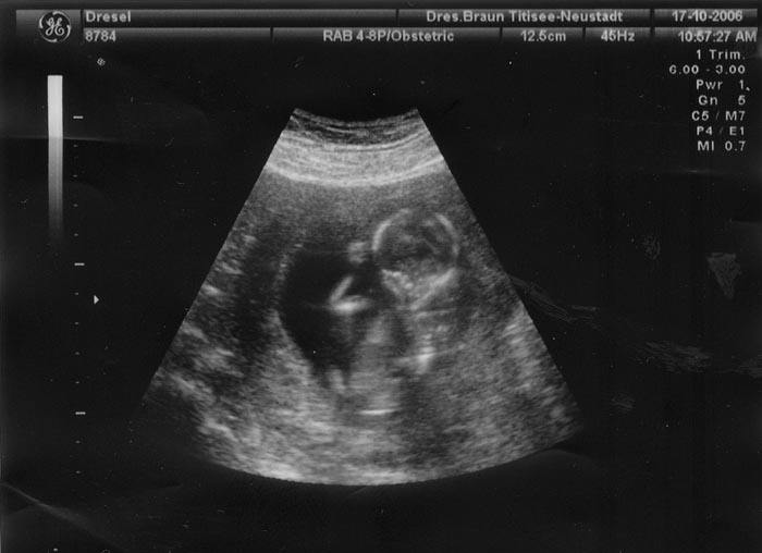 3. Ultraschallaufnahme