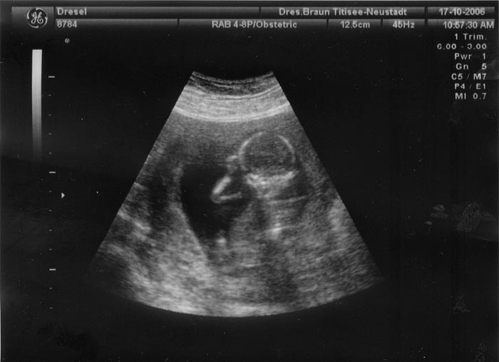 4. Ultraschallaufnahme