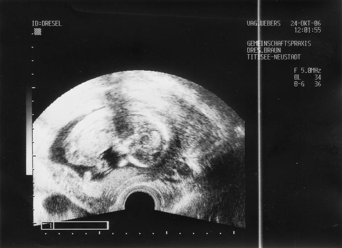 5. Ultraschallaufnahme
