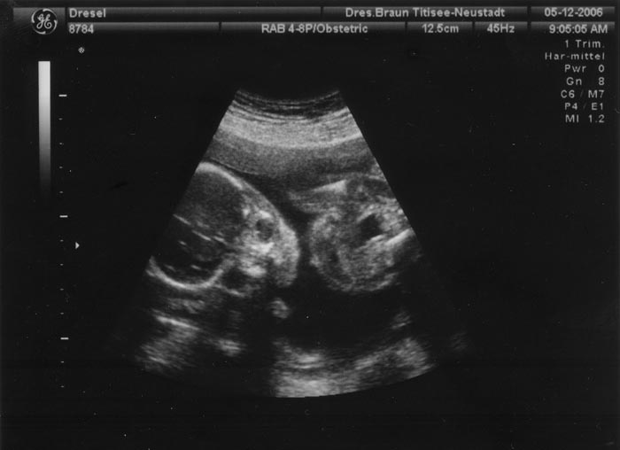 6. Ultraschallaufnahme