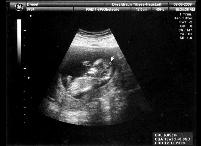 4. Ultraschallaufnahme